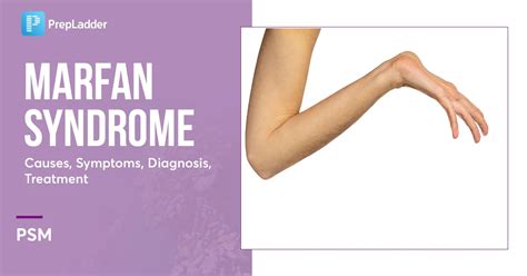 Marfan Syndrome Causes Symptoms Diagnosis Treatment