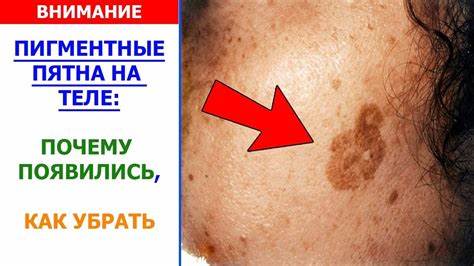 Я убрала отвисший живот