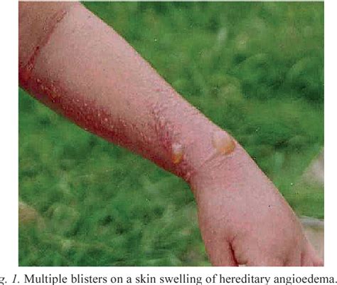Figure 1 From Acute Edema Blisters On A Skin Swelling An Unusual