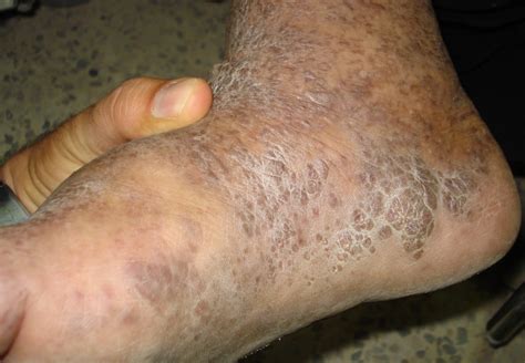Skin Tumors Kaposi Sarcoma