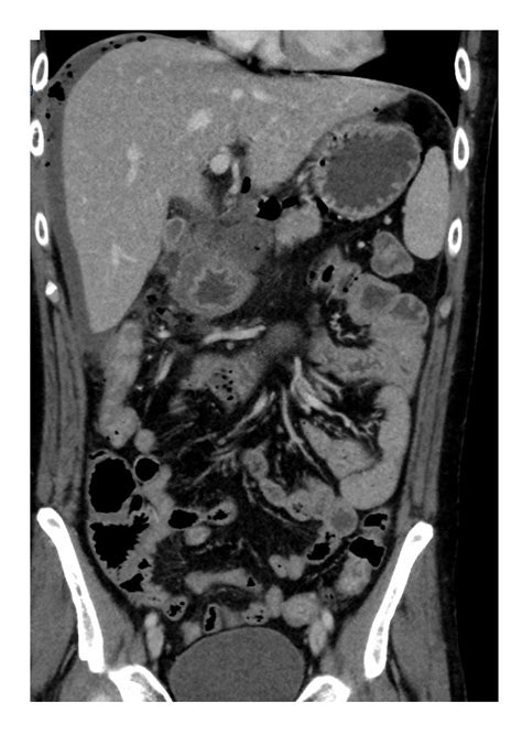 Imaging Case Of The Week 288 Answer Emergucate