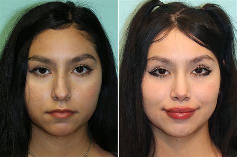 Lip Augmentation Photos Chevy Chase Md Patient 25289