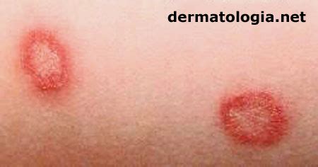 A doença geralmente se manifesta na pele e também afeta os pulmões e o cérebro. Micoses superficiais da pele - Dermatologia.net