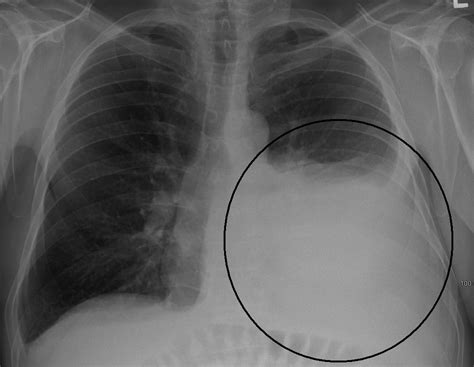 Derrame Pleural A Esquerda