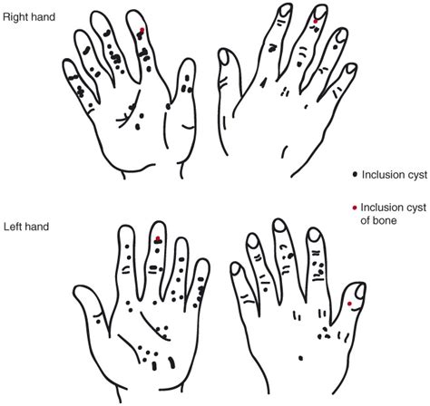 Epidermoid Cysts In The Hand C J Lincoski D C Bush S J Millon