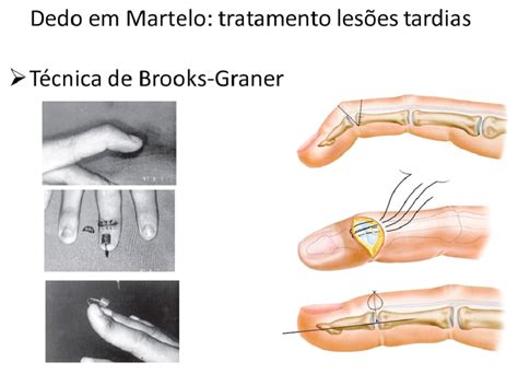 Dedo Martelo Cirurgia Da M O