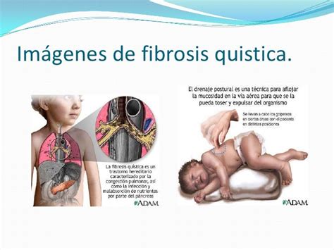 Fibrosis Quistica