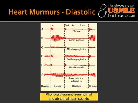 heart murmurs aortic regurgitation and mitral stenosis usmle first heart murmur