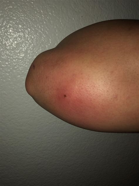 Bump On Elbow With Pus Drainage What Is This Diagnoseme