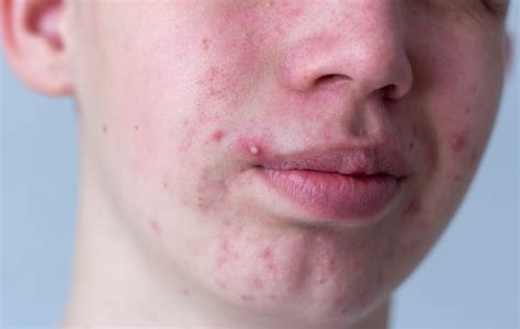 Everything You Need To Know About Clindamycin For Acne