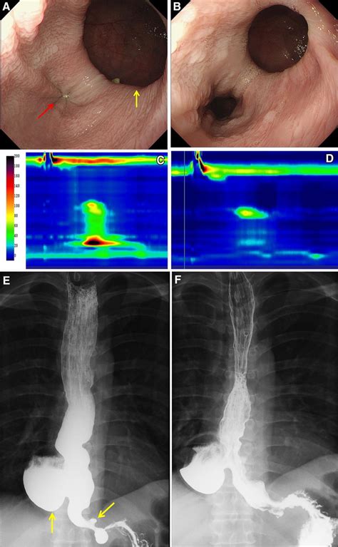A Case Of Type Iii Achalasia In A Patient Images Before And 3 Months