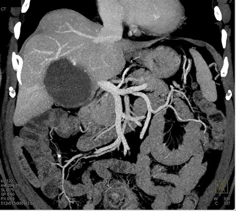 Liver Abscess Liver Case Studies Ctisus Ct Scanning