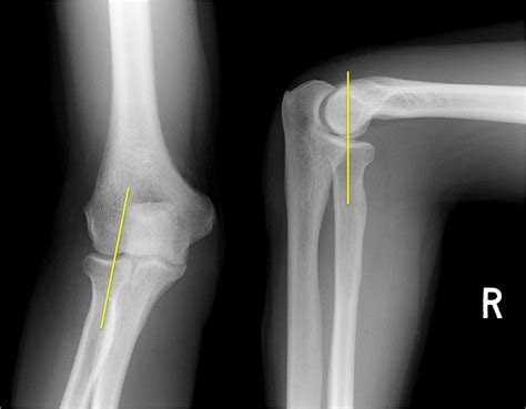 Elbow X Ray Anatomy