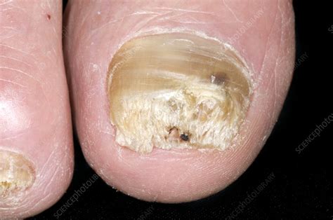 Psoriasis Of The Toe Nails Stock Image C0029657 Science Photo