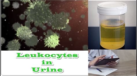 Leukocytes In Urine No Nitrates Youtube
