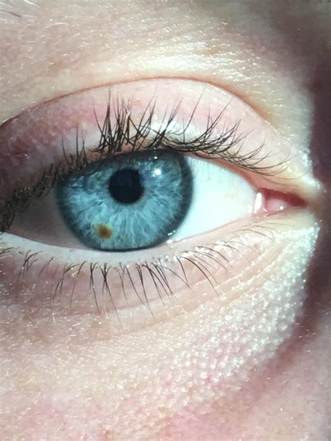 My Friends “eye Freckle” Rmildlyinteresting