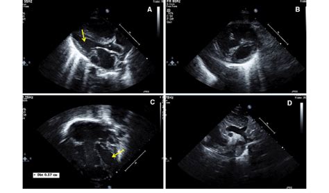 Two Dimensional Transthoracic Echocardiogram A Parasternal Long Axis