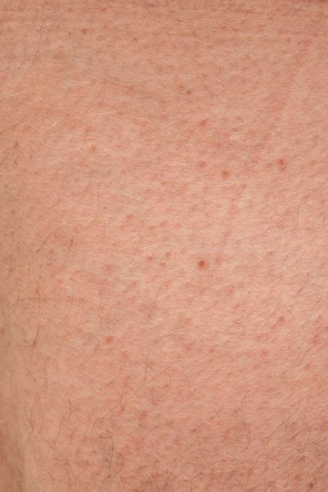 11 Ways To Get Rid Of Keratosis Pilaris For Good Coconut Oil For Skin