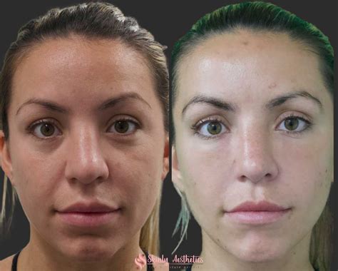 Under Eye Fillers Before And After Results At Skinly