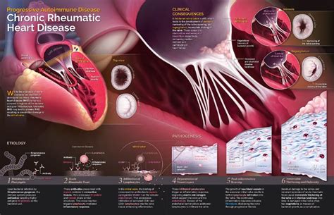 Chronic Rheumatic Heart Disease Progression Via Felixvis Medical