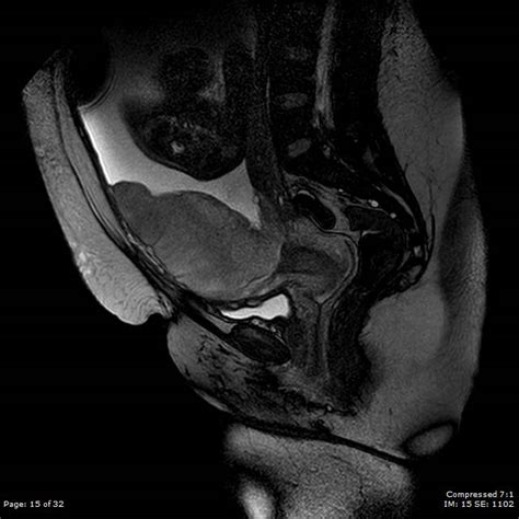 Complete Placenta Previa Image