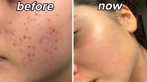 How I Cleared My Skin My Acne Journey Youtube