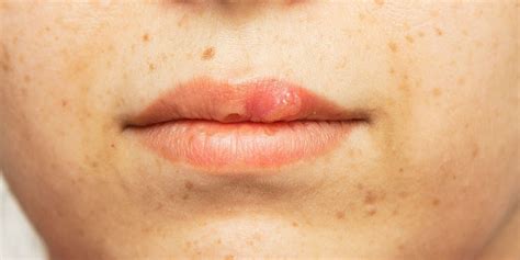 Dark Spots Around The Mouth Everything You Need To Know About Treating