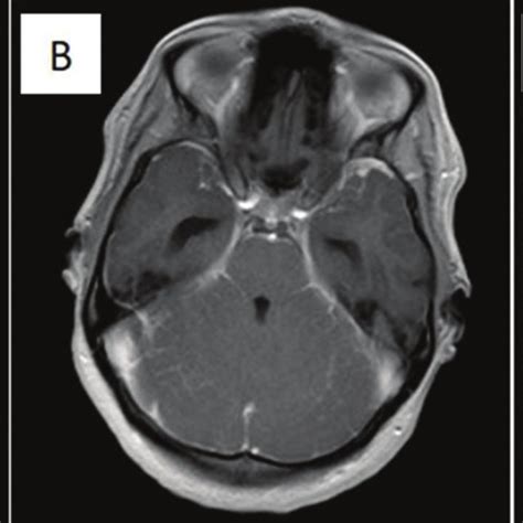 Brain Mri Demonstrating Cerebellar Inflammation A Brain Magnetic