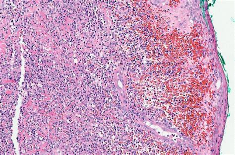 Pathology Outlines Pyoderma Gangrenosum