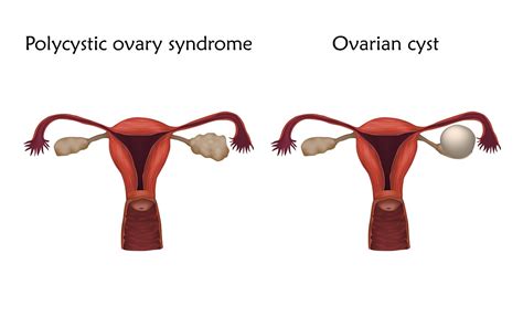 ovarian cysts types symptoms treatment remedies images credoweb