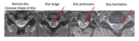 Understanding Your Cervical Mri Rocky Mountain Brain And Spine