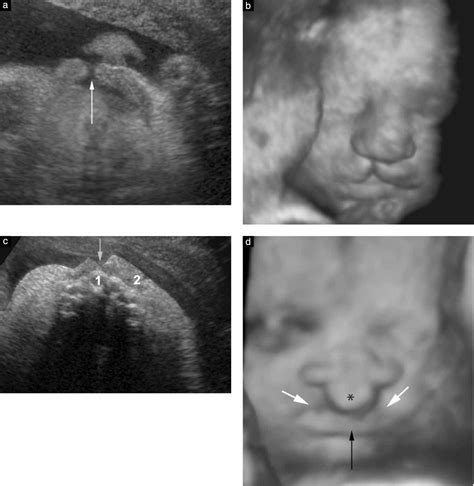 Two‐ And Three‐dimensional Sonographic Assessment Of The Fetal Face 2