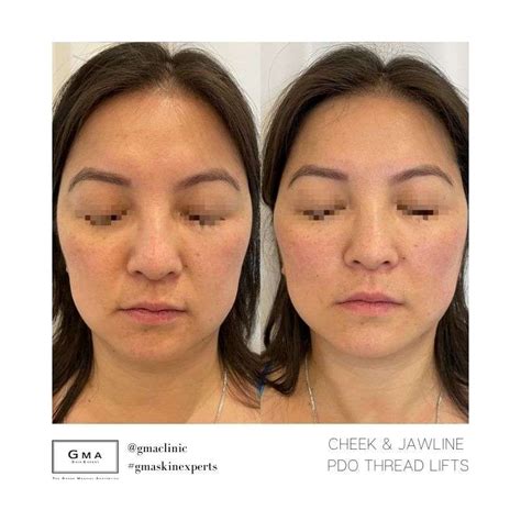 Pdo Thread Lift The Grand Medical Aesthetic Clinic