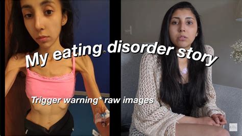 My Eating Disorder Story Anorexia Bulimia Orthorexia Raw With