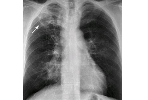 Tuberculosis And Mycobacterial Pneumonia Cancer Therapy Advisor