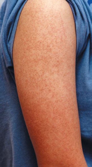 Common Keratosis Pilaris On Arms Keratosis Pilaris Treatment Options