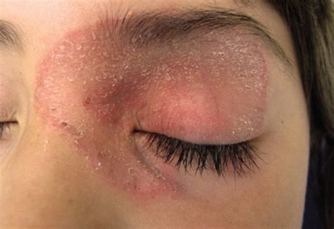 Dry Patch Of Skin On Eyelid Pictures Photos