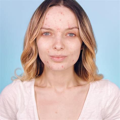 Embracing Your Acne Is The Newest Beauty Trend Of 2018 22 Words