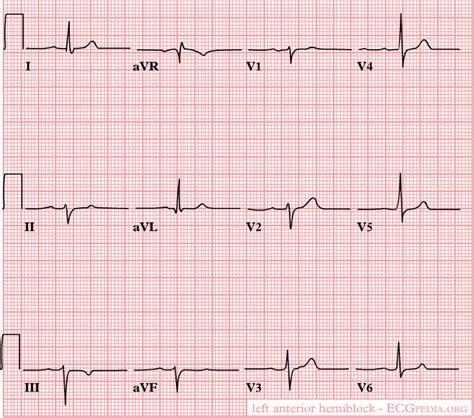 Intraventricular Conduction Delay Ekg Examples Wikidoc