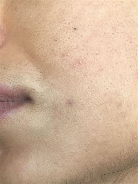 What Are These Little Bumps On My Face Non Acne Bumps On Face 2020 Vrogue