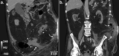 Admission Ct Images Demonstrating The Abscess Forming A Sinus Tract