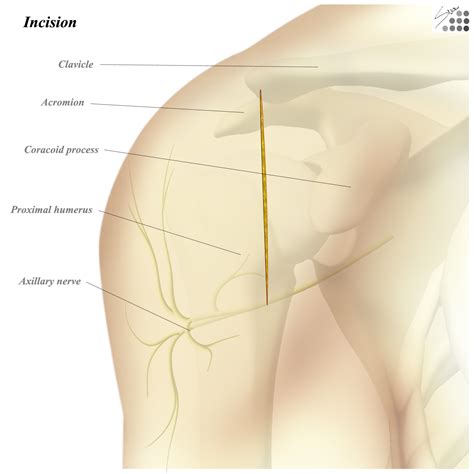 Shoulder Anterolateral Approach Approaches Orthobullets