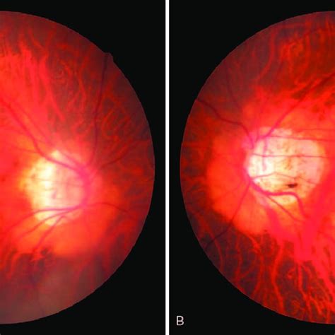 Fundus Photographs Of The Patients Right And Left Eyes Obtained At The