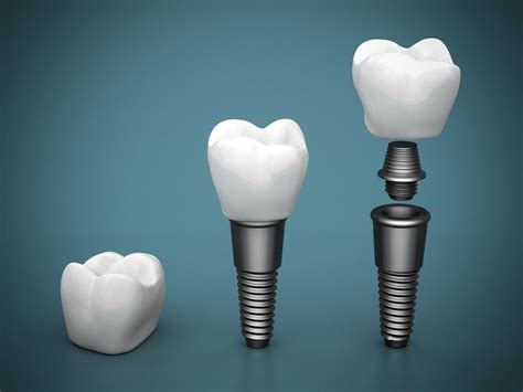 All On 6 Dental Implants Technique Procedure And Price Body Expert