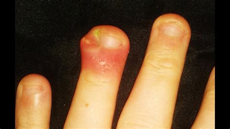 Cysts Warts Ingrown Nails Blisters And Boils Mystery Diagnosis