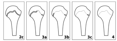Schematic Drawings Of The Stages Of The Proximal Humeral Epiphysis