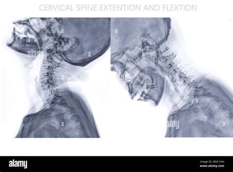 X Ray C Spine Or X Ray Image Of Cervical Spine Flexion And Extension