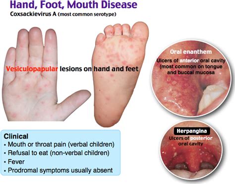 Hand Foot Mouth Disease Justin Abraham