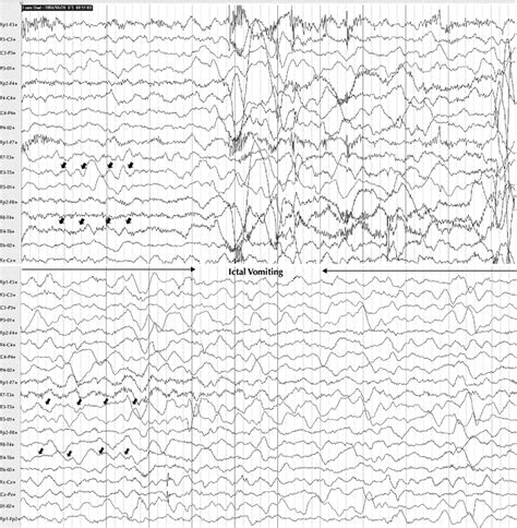 The Eeg Background Showed Asymmetric And Discontinued Delta Rhythm