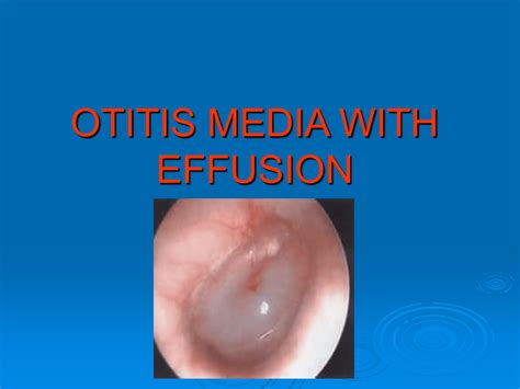 Otitis Media Symptoms And Preventions Infographic Sto Vrogue Co